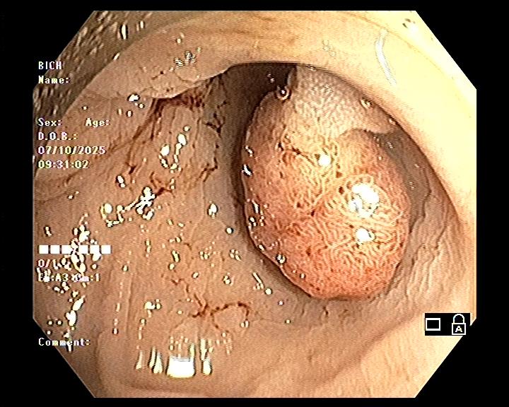 /images/companies/2025/2025 1/Polyp đại tràng.jpg